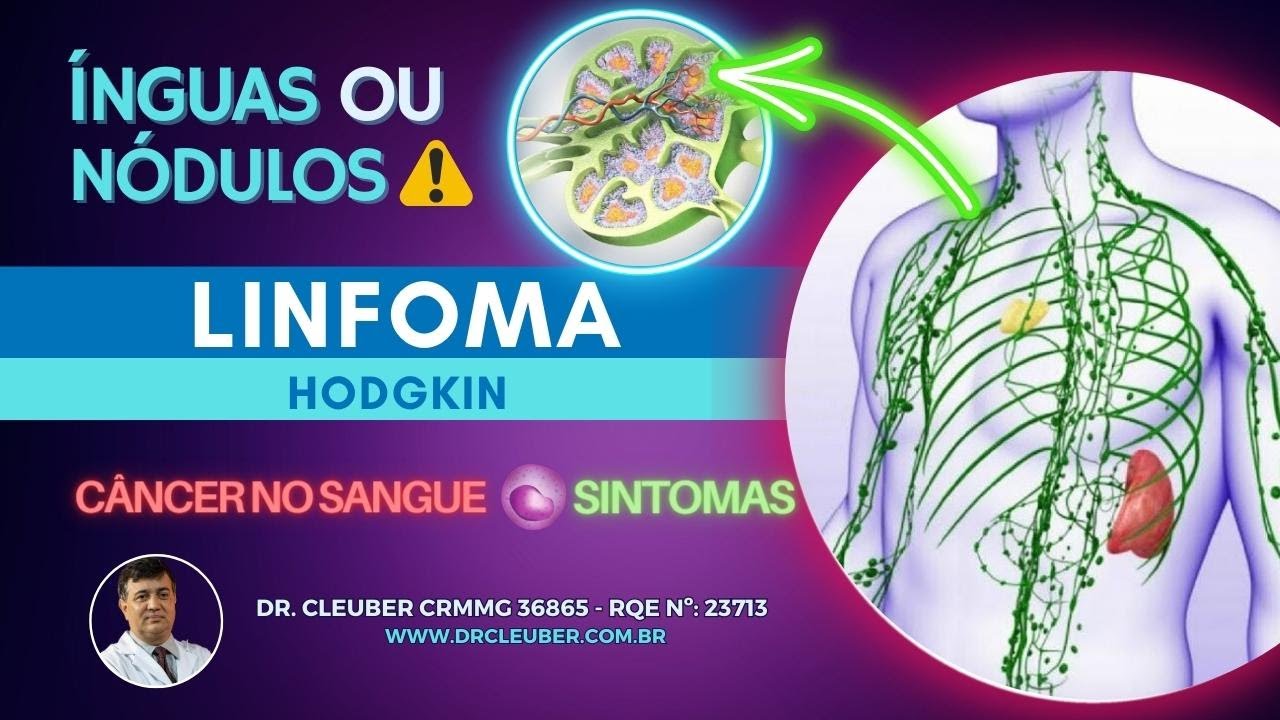 🟢 Linfoma de Hodgkin: O que é? ⚠️ Cuidado com Ínguas e Caroços.