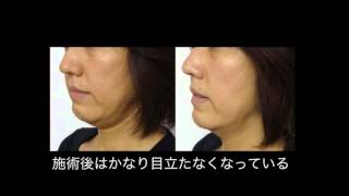 ビューティライザ- ブレスの施術例のご紹介