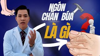 NGÓN CHÂN BÚA LÀ GÌ    HAMMER TOES   BS NGUYỄN MINH TẤN