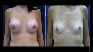 ד"ר אבישי וינברגר - הגדלת חזה, הרמת חזה, הקטנת חזה