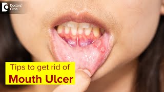 Mouth Ulcer| Mouth Sores: Symptoms, Treatment & Prevention Methods-Dr.Lahari A.S.R | Doctors