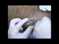 pelvic external fixation video lecture CMU