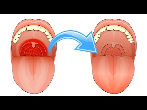 Top 10 Natural Remedies for Sore Throats