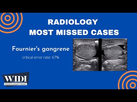 Most Missed Cases: Fournier's Gangrene