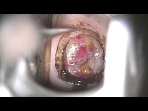 Video fisioterapia in osteocondrosi lombare Vitamine e farmaci per legamenti e articolazioni