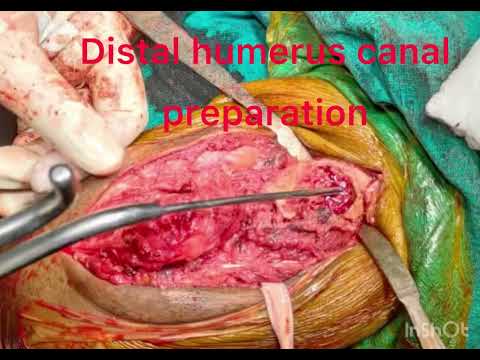  Total Elbow Replacement | Hyderabad | Dr.Sudheer Kumar Pothu