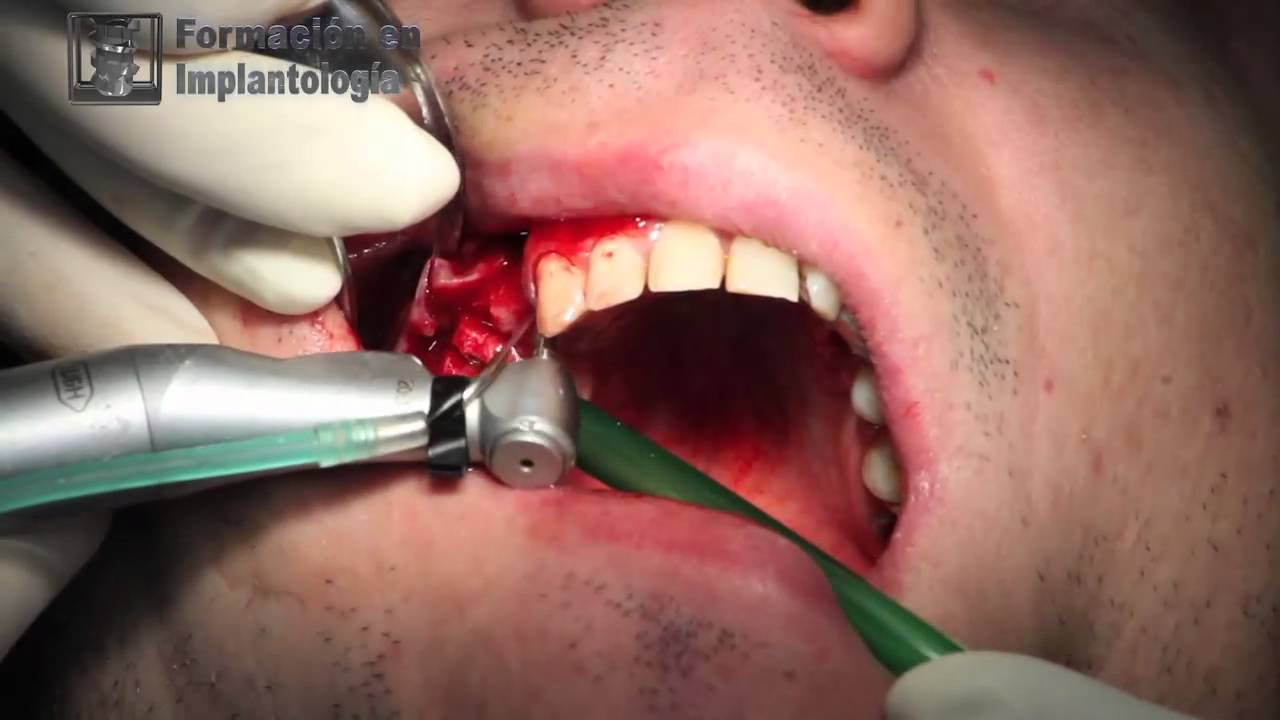 Elevación de seno y relleno con xenoinjerto con implantes GMI