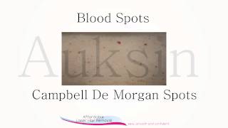 How To Get Rid Of Blood Spots Also Known as Campbell De Morgan Spots