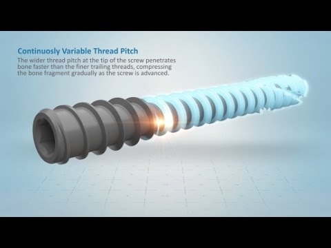 Acutrak 2 Headless Compression Screw System Overview