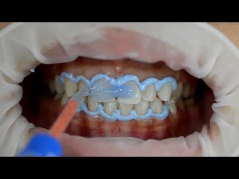 Clareamento dentário de consultório (Pola Office+ SDI)