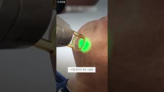 레이저 제모 성형 시술