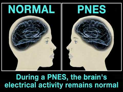 PNES's: Psychogenic Non-Epileptic Seizures (Health Guru)