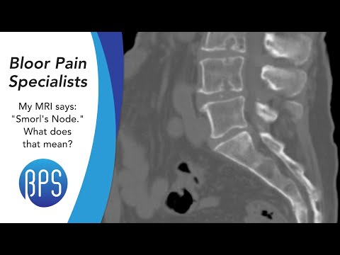 My MRI Says "Schmorl's Node." What Does That Mean? - Common MRI Questions ANSWERED