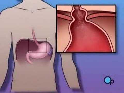 PreOp® Patient Education Minimal: Hernia Hiatal Laparoscopic