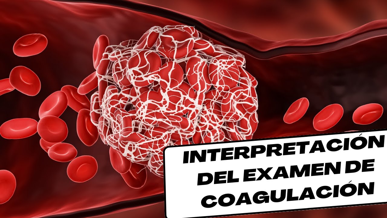 Interpretación de Pruebas de coagulación