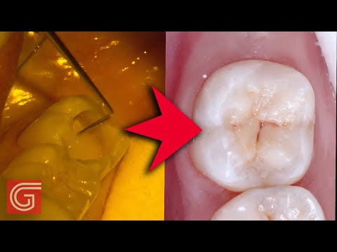 Leczenie ubytku próchnicowego na powierzchni żującej zęba 47 - część 2