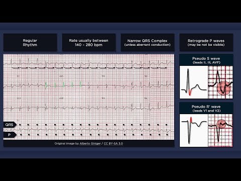 Atrioventricular Nodal Re-entry Tachycardia (AVNRT) ECG