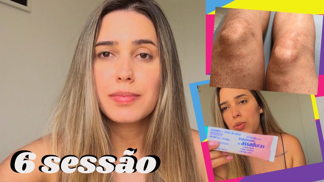 MINHA 6 SESSÃO DEPILAÇÃO A LASER, MACHOU A MINHA + PRODUTOS QUE ESTOU USANDO