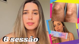 MINHA 6 SESSÃO DEPILAÇÃO A LASER, MACHOU A MINHA + PRODUTOS QUE ESTOU USANDO