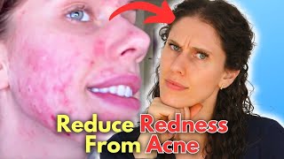 The Only 3 Ingredients That Stop Acne Redness In 60 Days!