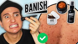 I tried Banish skincare for 2 WEEKS to fade my ACNE SCARS! (someone call the lord)