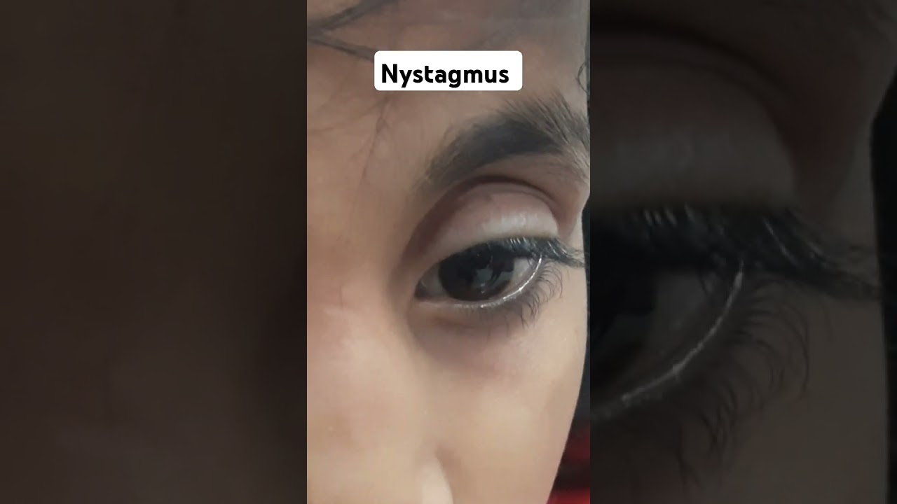 NYSTAGMUS