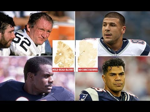 Aaron Hernandez had the most severe CTE case ever seen