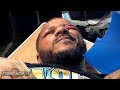 ANTHONY DIRRELL GETS NASTY CUT STITCHED UP AFTER ANVI YILDIRIM FIGHT