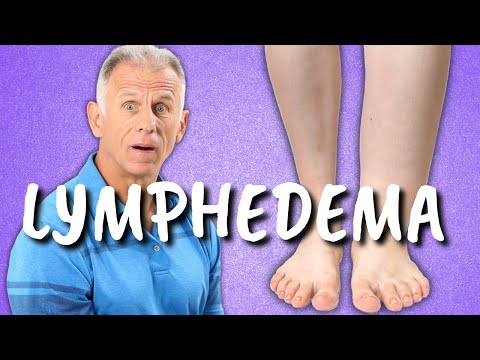 papillómák és lymphedema