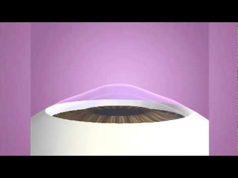 Conductive Keratoplasty CK