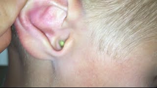 HELP! SOMETHING&#39;S STUCK IN MY EAR