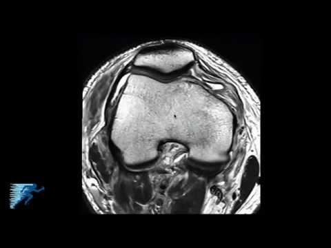 artrózisos kezelés zsírral ízületi betegség diagnosztizálása