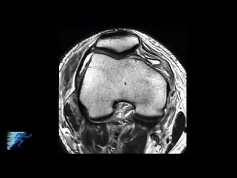 ahol a rheumatoid arthrosis kezelésére artrózis modern kezelési rendjei