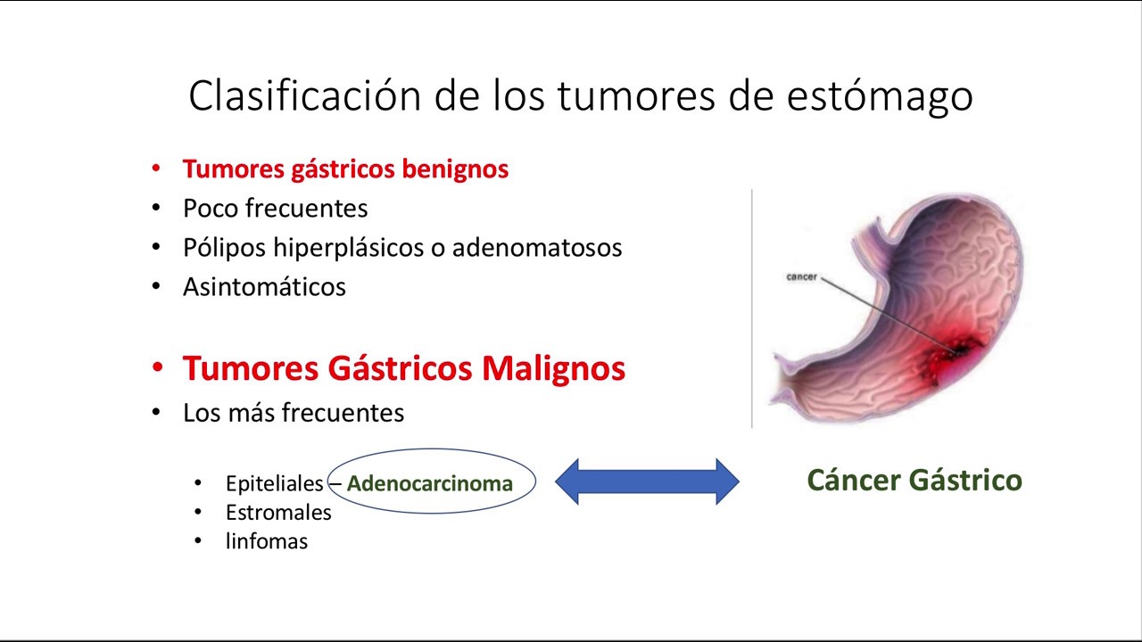 Cáncer Gástrico. Generalidades, Clínica y Diagnóstico