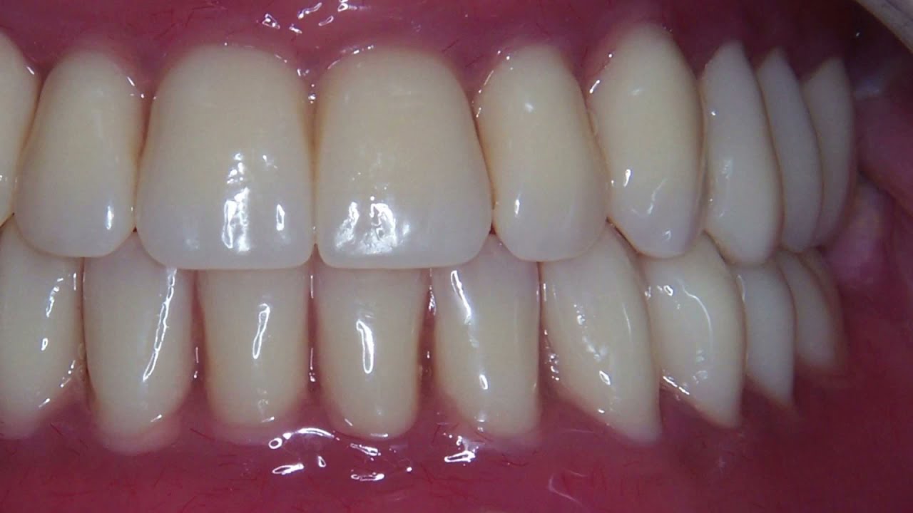 Całkowite protezy osiadające u bezzębnego pacjenta