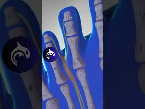 Morton's Neuroma of the Foot #feet #foot