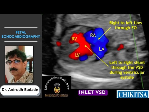 Fetal Echocardiography Basics [Ultrasound] | Dr. Anirudh Badade