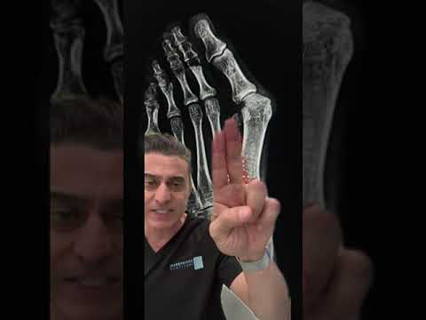 Doctor Responds To Backlash Over Bunion Gadget Working!