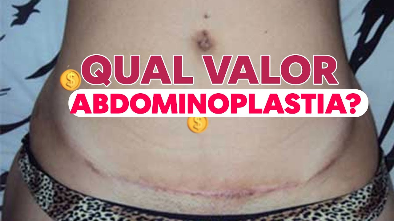 QUAL VALOR DE UMA ABDOMINOPLASTIA 2022