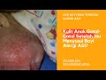 Kulit Anak Gatal Gatal Setelah Ibu Menyusui Bayi Alergi