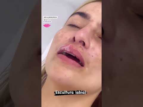 Aumento de labios con ácido hialurónico Santa Marta - Albeiro Garcia Varela