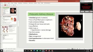 Polycistic & Kidney Stones: Kidney Part 2