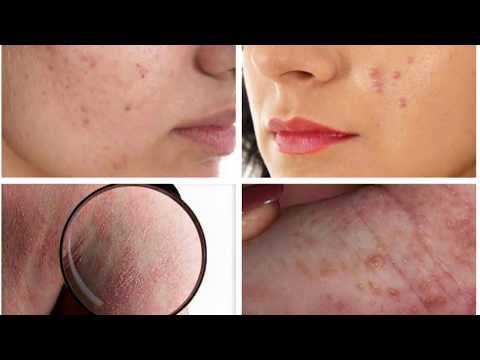 Sarsa homoeopathic blood purifier