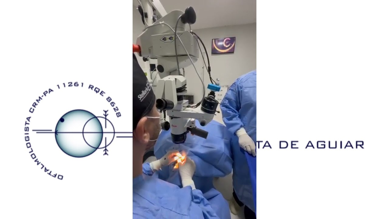 Cirurgia de Ceratocone - Anel Estromal