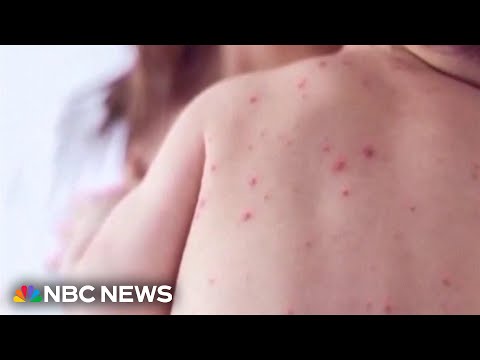 Measles cases on the rise since the start of the year 