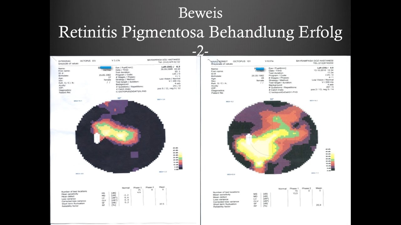 Gesichtsfeldtests 2- Retinitis Pigmentosa Behandlung (Retinopathia Pigmentosa) - FIRATLI KLINIK