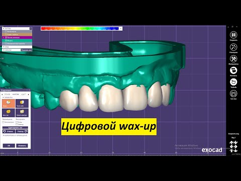 EXOCAD Моделировка waxup для дальнейшей печати модели. Цифровое моделирование зубов