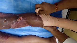 Crepe Bandaging