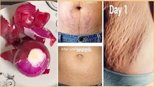 Onion in 10 days remove stretch marks completely / Onion in 10 days permanent stretch mark removal