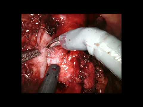 Robotic Retroperitoneal Lymph Node Dissection On A Post-chemo Metastasis From Testicular Seminoma